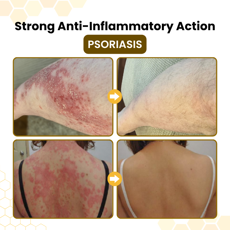 Luxlne® PsoriaSoothe Bee Venom Skin-Restoration Cream