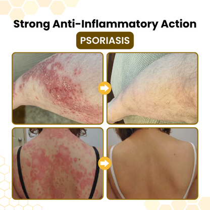 Luxlne® PsoriaSoothe Bee Venom Skin-Restoration Cream